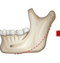 下頜角整形手術