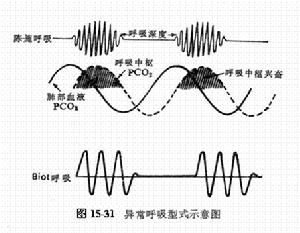 呼吸肌疲勞