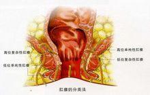 肛瘺病理圖