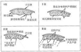 胎盤成熟度