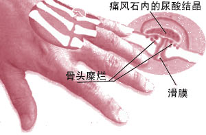 痛風性關節炎