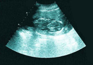 胎停育的B超檢查
