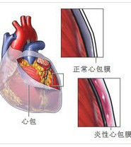 心包填塞