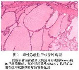 毒性結節性甲狀腺腫