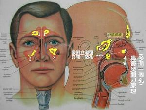 鼻惡性肉芽腫