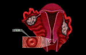 婦科疾病
