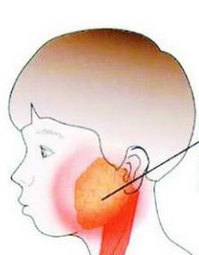 急性腮腺炎性睪丸炎