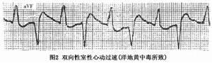 雙向性室性心動過速