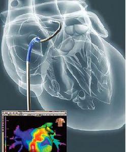心導管射頻消融術