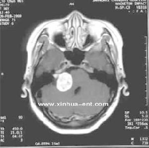 聽神經瘤
