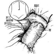 示意圖8:切斷肝三角韌帶