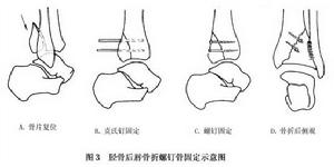 脛骨後唇骨折