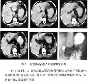 後壁穿孔性潰瘍