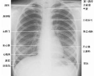 正常胸部X線解剖