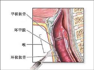 先天性喉下垂