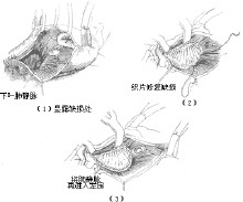 心房間隔缺損