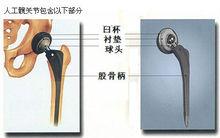 人工髖關節