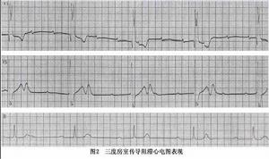 心臟傳導阻滯