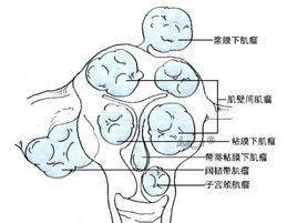 多發子宮肌瘤