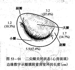 風濕性二尖瓣狹窄