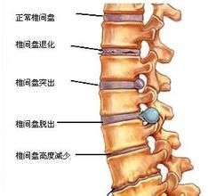 腰椎盤突出