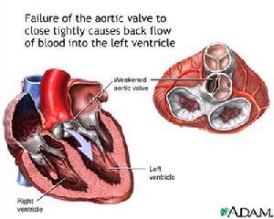 主動脈瓣關閉不全