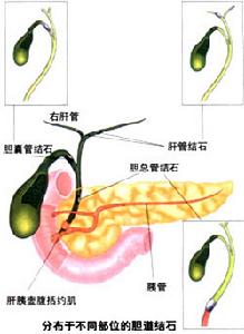 妊娠合併急性膽囊炎