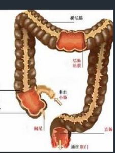 慢性直腸炎