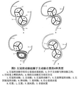 冠狀動脈異常起源主動脈