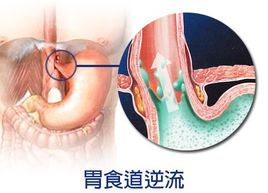 胃食道逆流疾病