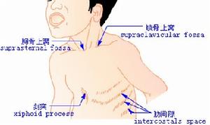 新生兒顱內出血