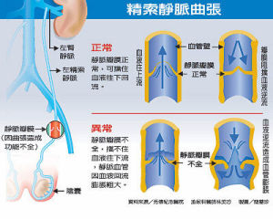 精索靜脈曲張