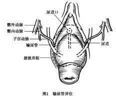 陰道後壁脫垂