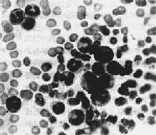（圖）幼年型粒-單核細胞白血病