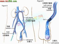 精索靜脈結紮術