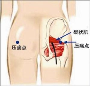 梨狀肌損傷綜合症