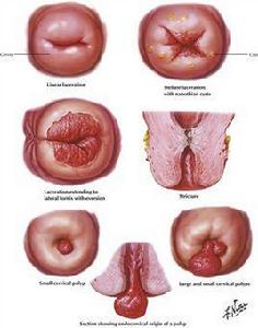 宮頸陳舊性裂傷