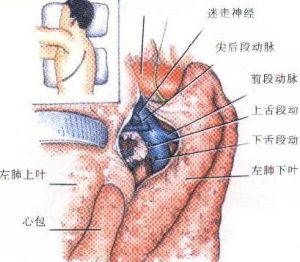 胸膜間皮瘤