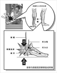 跟腱損傷