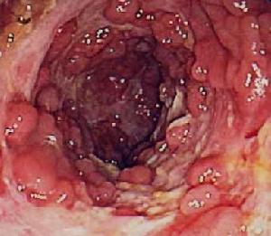 腸道腫瘤