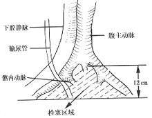 髂內動脈栓塞術