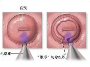 宮頸錐形切除術