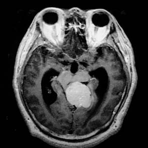 小腦腦橋角腦膜瘤