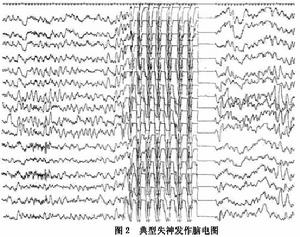 全面性發作