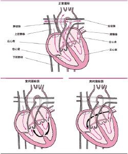 小兒室間隔缺損