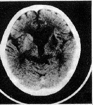 外傷性腦積水