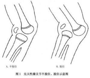 先天性膝關節脫位