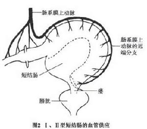 先天性短結腸