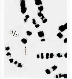 21三體綜合徵