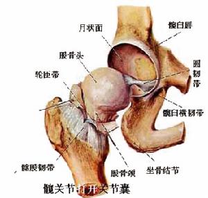 股骨頭無菌性壞死